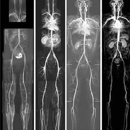 Whole Body CT Angiography Test